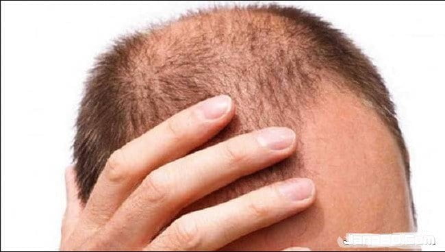 The cause of hair loss in boys and what to do