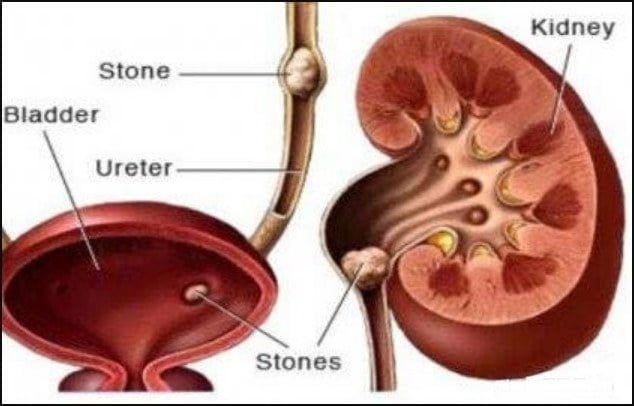 How to get rid of kidney stones easily at low cost